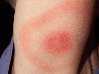 870px Erythema migrans erythematous rash in Lyme disease PHIL 9875